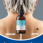 Dile Adios a las Verrugas con VerryClean + Envio Gratis